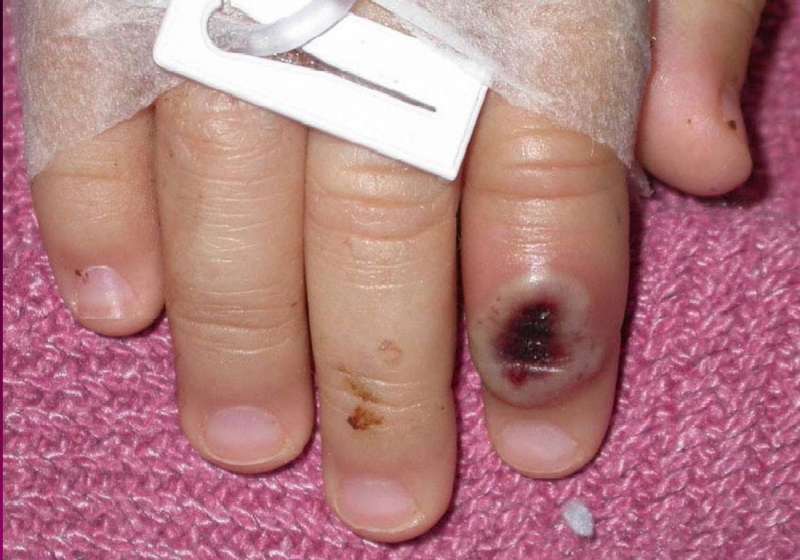 Fotografía en la que se aprecia el dedo de un niño infectado por la llamada 