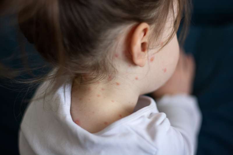 Se recomienda prestar atención a síntomas como fiebre alta, tos, conjuntivitis o erupción cutánea, y consultar con un profesional sanitario ante la sospecha de exposición o la aparición de signos compatibles