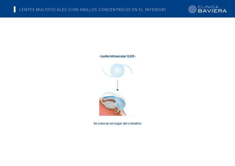 5822_lentes_multifocales_-_Baviera.jpg